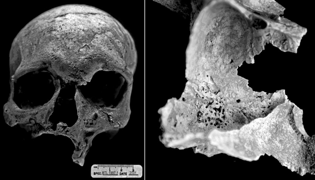Deformations on an approximately 4300-year-old skull at Balathal in India are the oldest confirmed skeletal evidence of leprosy.